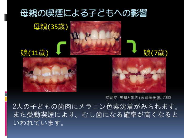 受動喫煙の子どもへの影響
