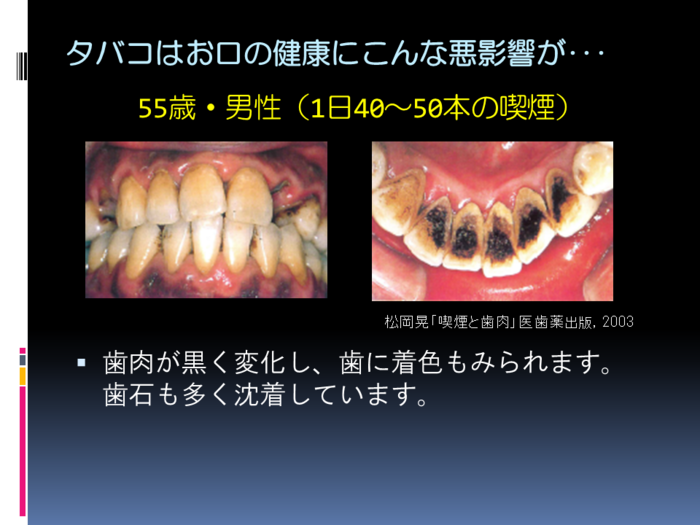 たばこを吸っている人の歯の様子 たばこを吸っている人の歯の様子