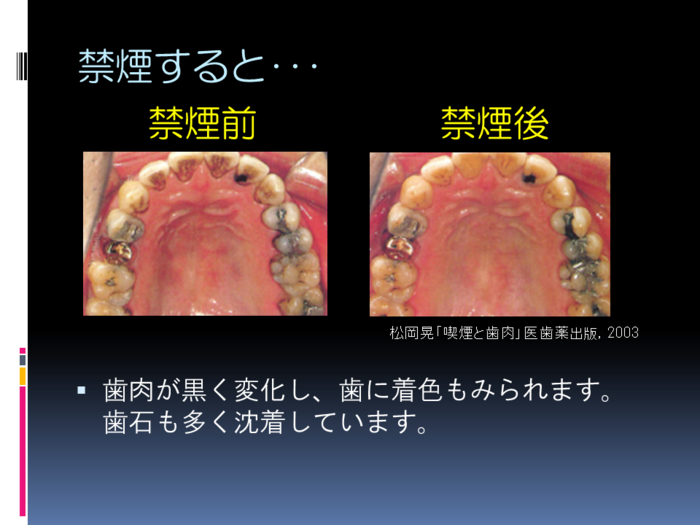 禁煙前、禁煙後の歯 禁煙前、禁煙後の歯