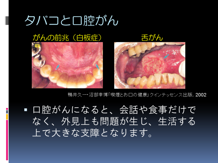 たばこと口腔がん2 たばこと口腔がん2